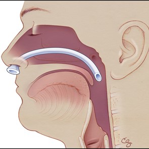 Nasopharyngeal Airway/NPA