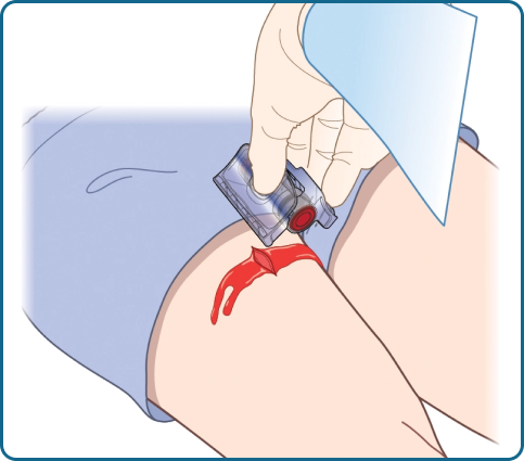 The iTClamp® Hemorrhage Control System