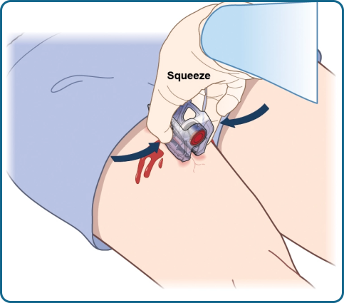The iTClamp® Hemorrhage Control System