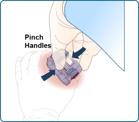 The iTClamp® Hemorrhage Control System